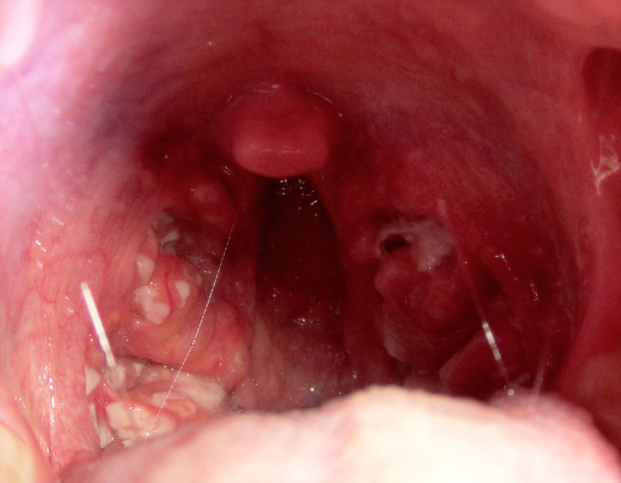Infected Tonsils Pics